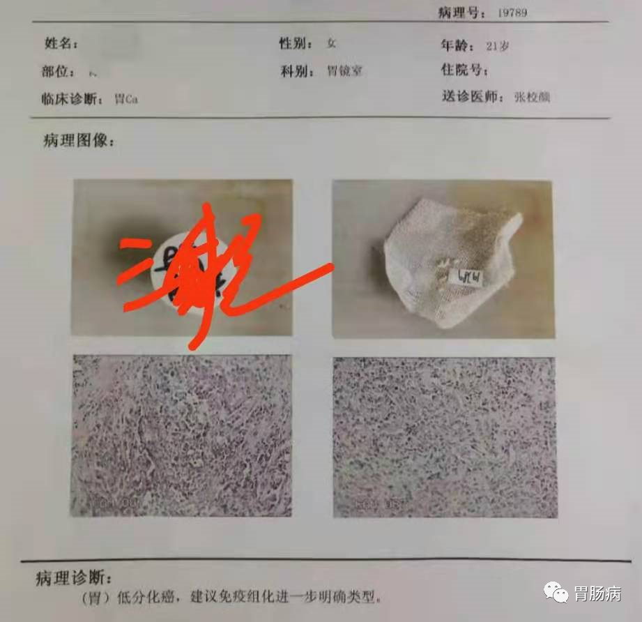 医生总结了3位年轻胃癌患者的病例:30岁不到的他们到底干啥了? 医生总结了3位年轻胃癌患者的病例:30岁不到的他们到底干啥了?