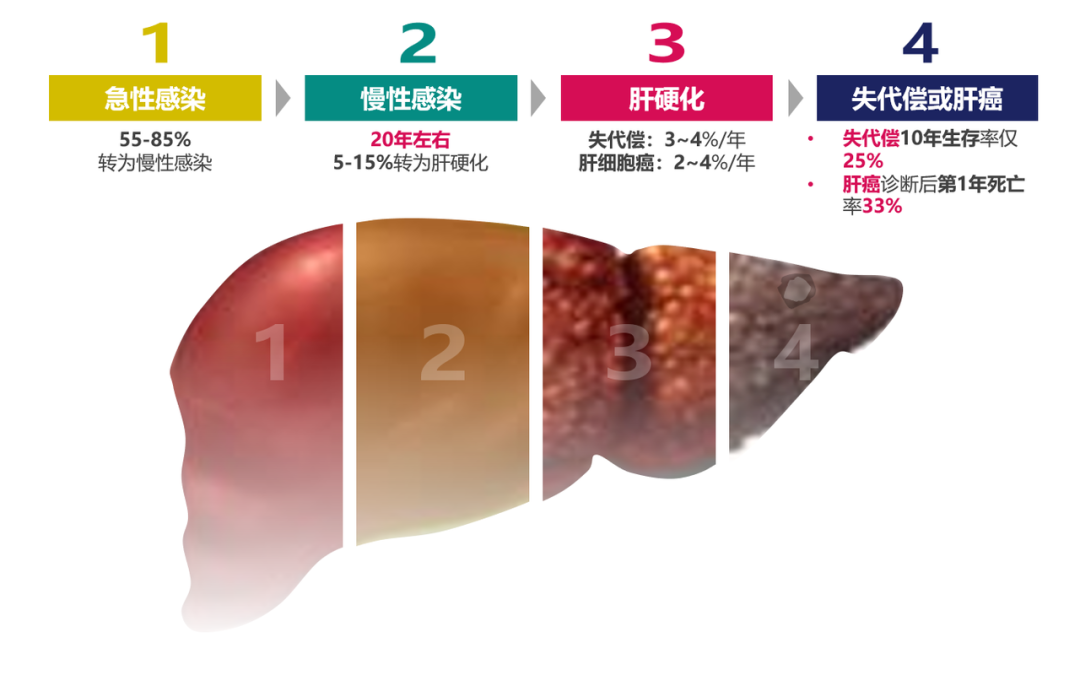 悄悄变成肝硬化、肝癌,很多人感染了却不知道 悄悄变成肝硬化、肝癌,很多人感染了却不知道